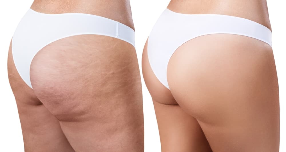 Smooth skin after non-invasive cellulite treatment