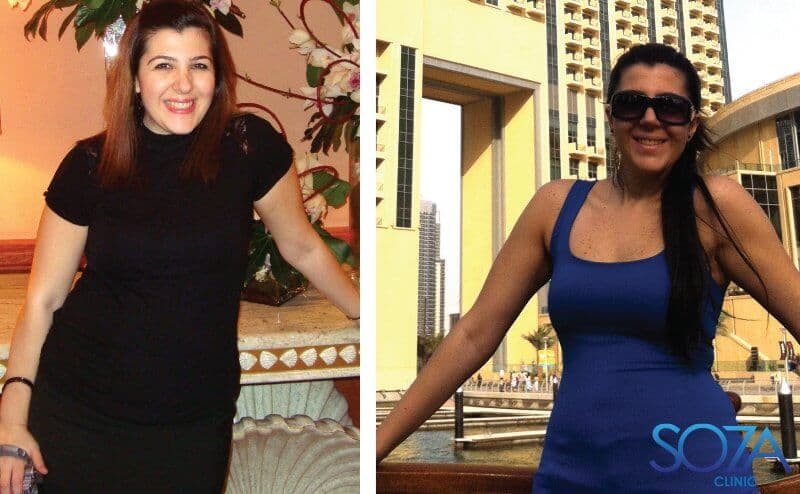 Soza Clinic patient before and after, photo 36