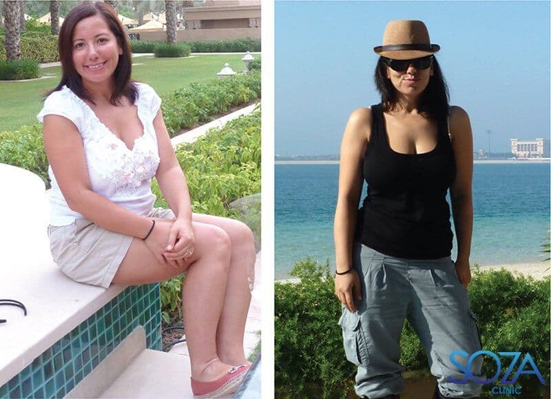 Soza Clinic patient before and after, photo 33