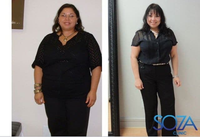 Soza Clinic patient before and after, photo 38