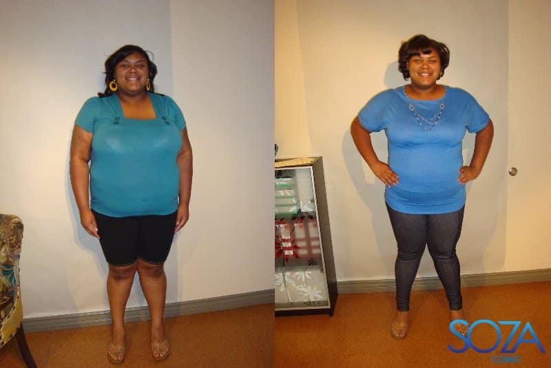 Soza Clinic patient before and after, photo 39