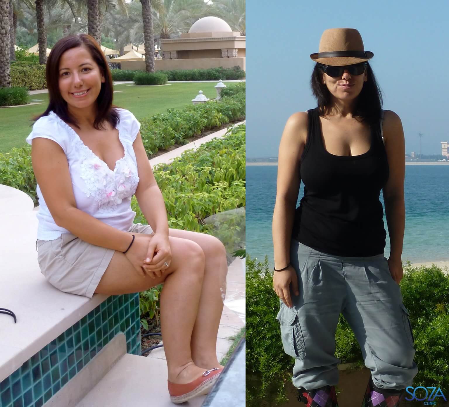 Soza Clinic patient before and after, photo 4