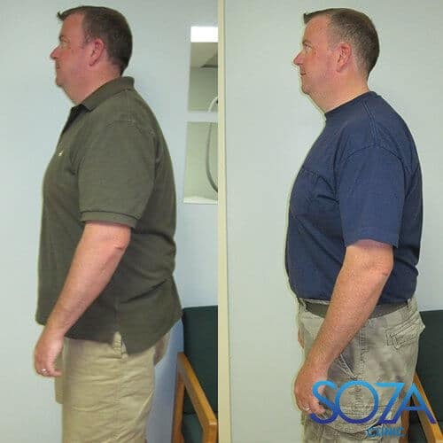 Soza Clinic patient before and after, photo 10