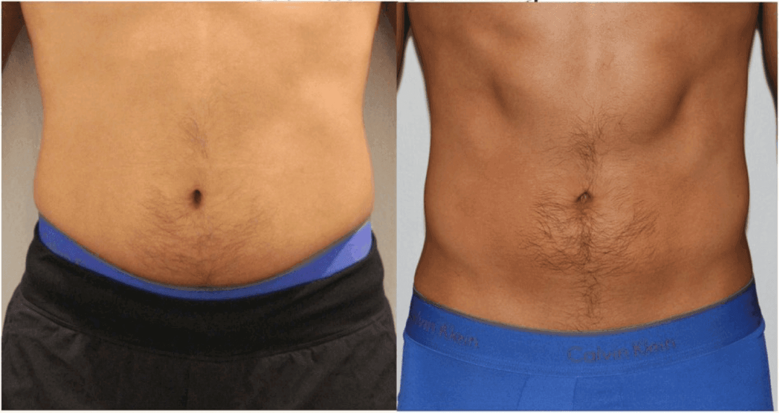 Soza Clinic patient before and after, photo 2