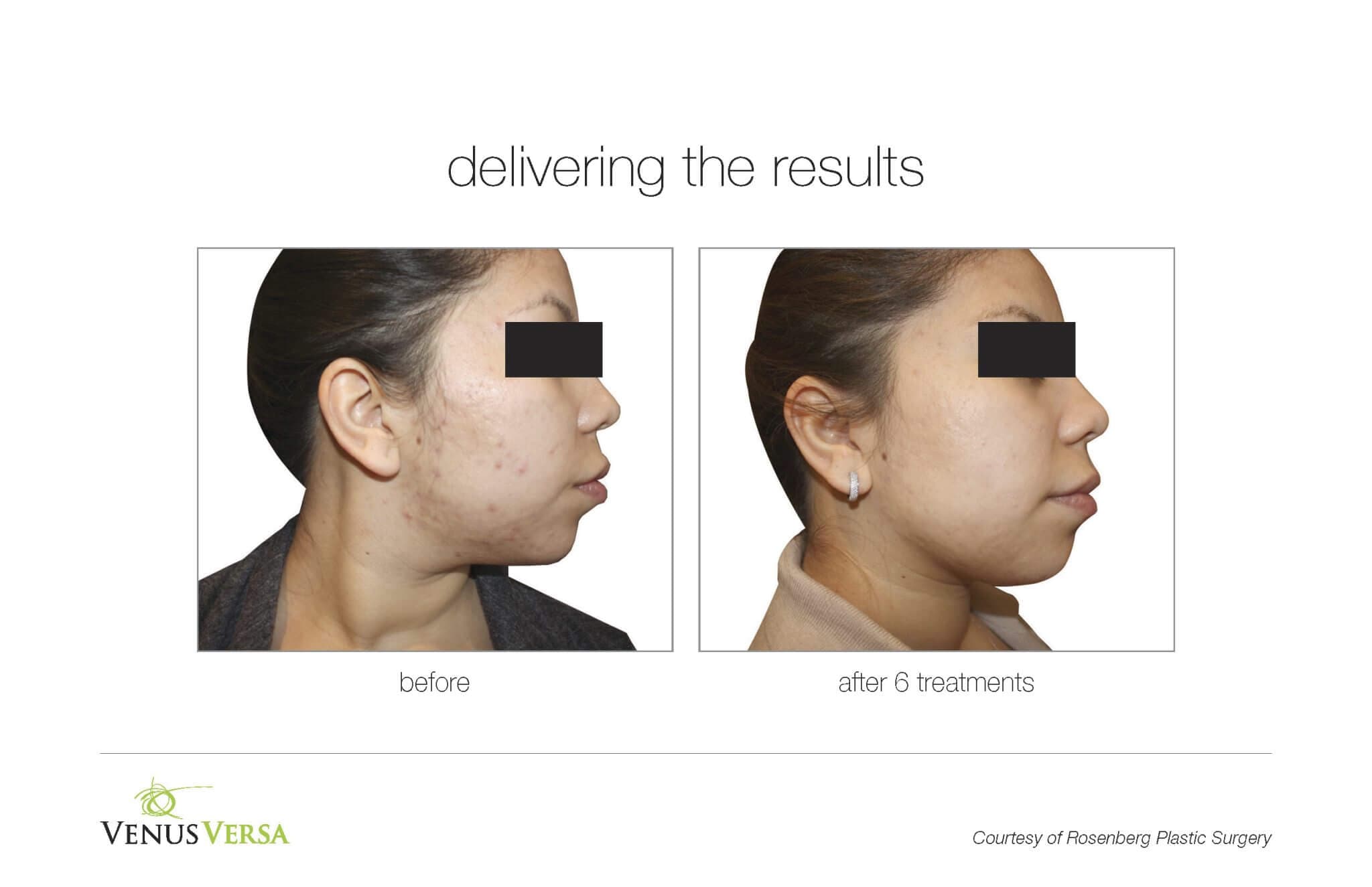 The Venus applicator used for non-surgical skin tightening